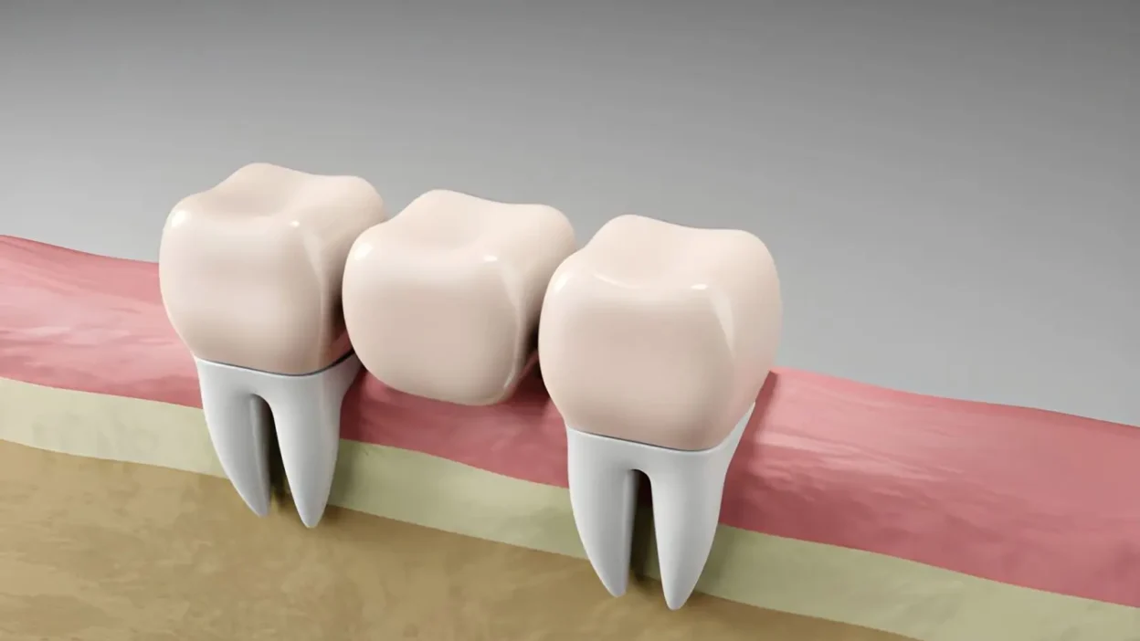 The Connection Between Periodontics And Longevity Of Restorations