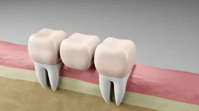 The Connection Between Periodontics And Longevity Of Restorations