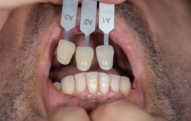 The Art Of Shade Matching For Multigenerational Restorations