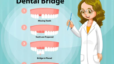 Dental Bridge 101: What You Need to Know Before Your Appointment